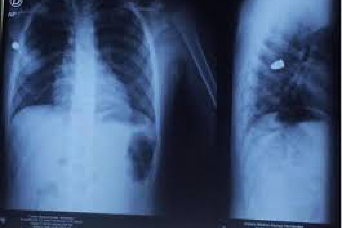 Proyectiles en el cuerpo